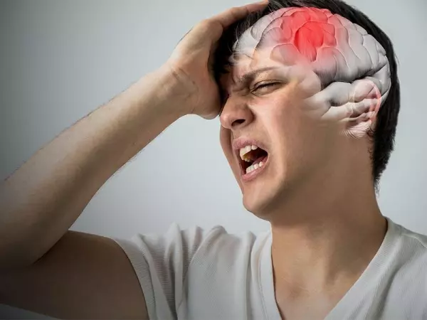 Đau đầu có thể là biểu hiện của đột quỵ não thoáng qua